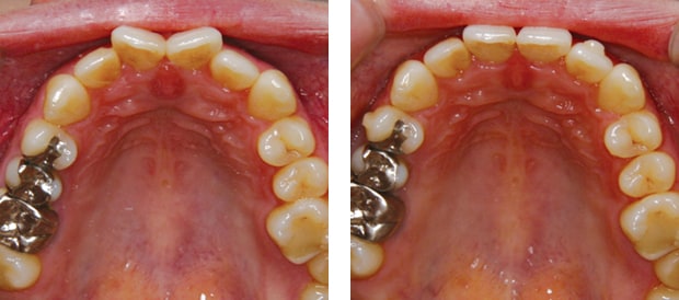 インビザラインでの歯の移動ペースと治療期間